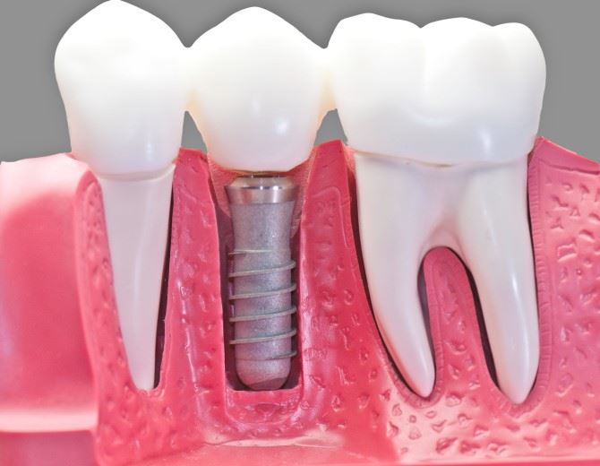 Implantes dentário