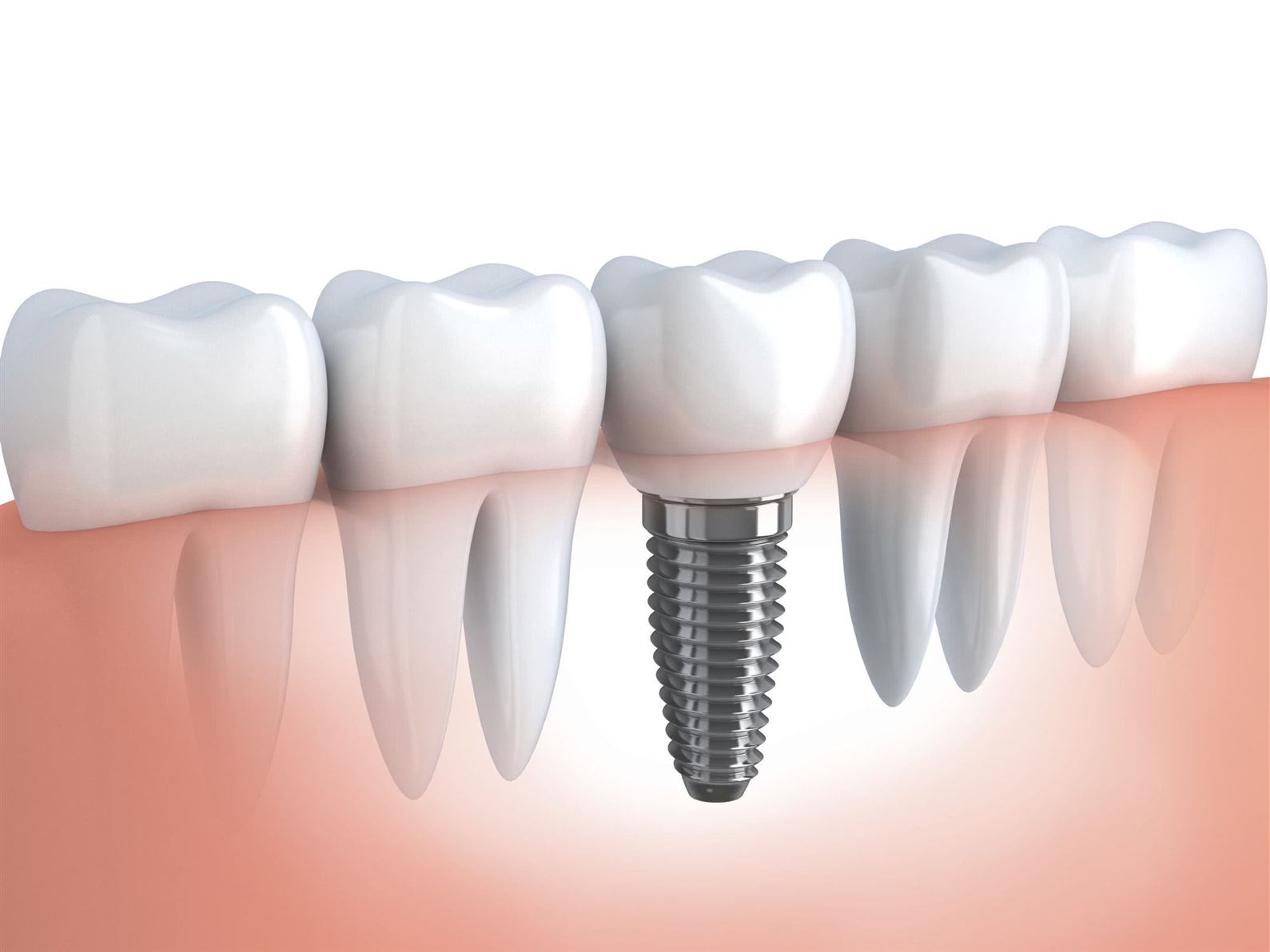 Implantes dentário