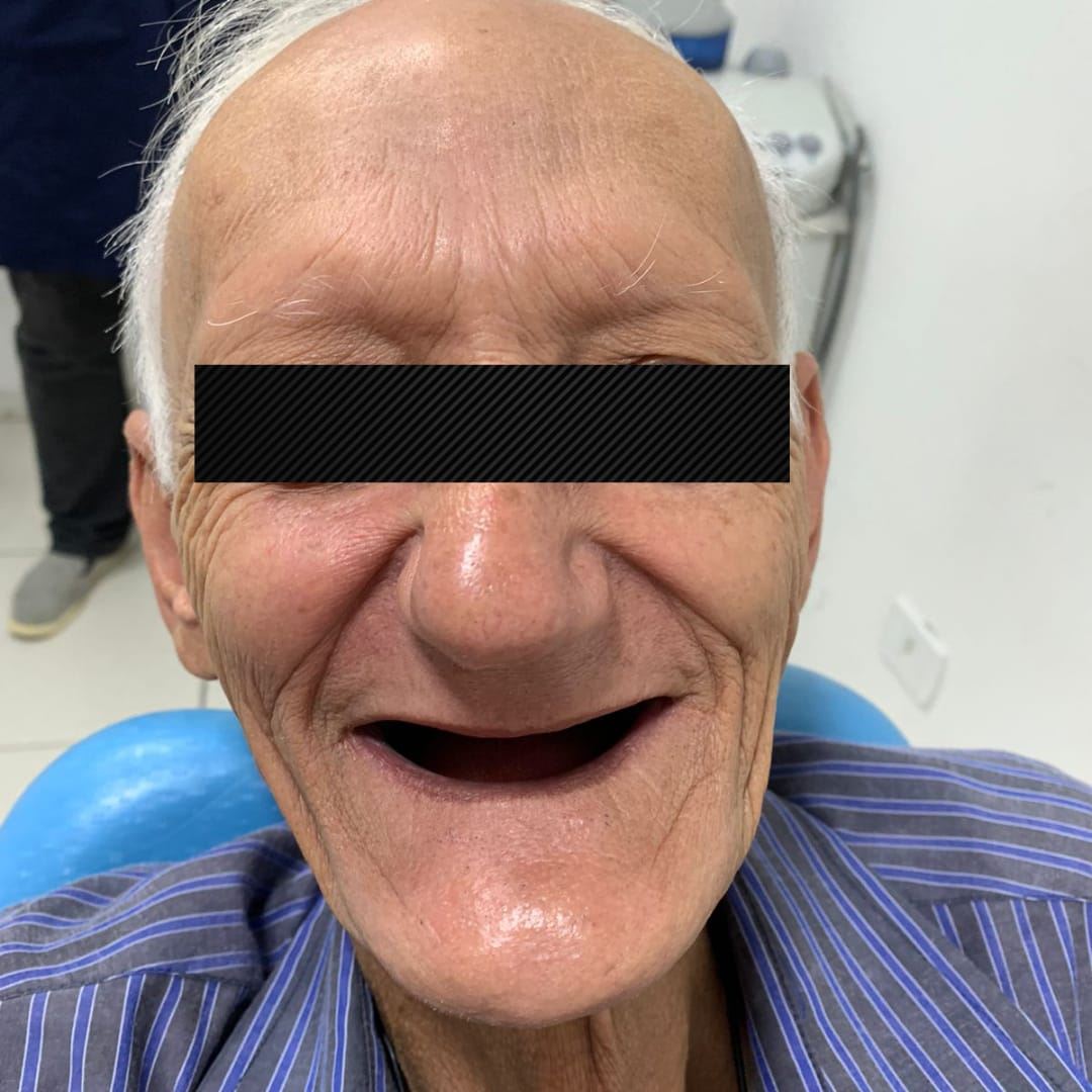 Antes da dentadura superior e inferior