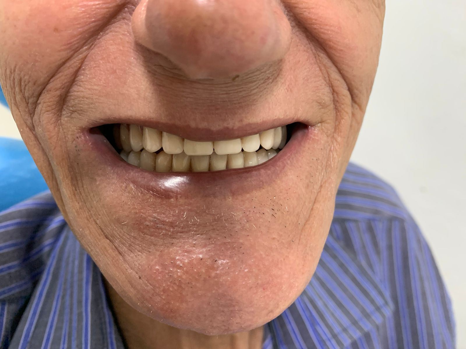 Depois da dentadura superior e inferior