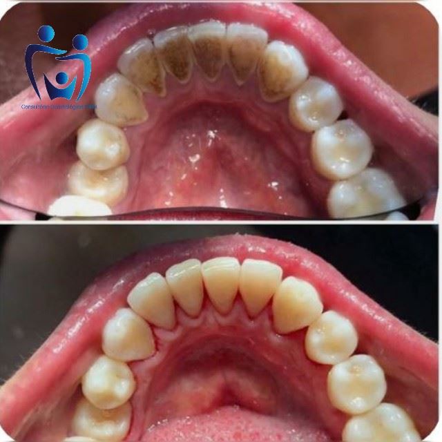 Se liga nesse antes e depois! 😱..... E você, esta com sua limpeza em dia ? Para saber o certo, a limpeza deve ser feita a cada 6 meses. 😉 Tá esperando o que?! Agende já sua avaliação, temos excelentes profissionais.... 😁
R: sete de setembro n14 centro Alfenas 
☎️3292-4926 ou (35) 99732-4038
Obs: Fotos 100% autorizadas pelo paciente!!! 😁🤩