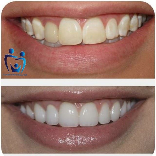 Olha só esse antes e depois !!! 😱 Após 3 sessões de clareamento...... Ficou um máximo não achou ? 🤩 
E você que sonha em ter seus dentes branquinhos, corra já para cá e não perca essa oportunidade de ficar ainda mais lindo (a) seu sorriso ......
R: Sete de Setembro N14 centro de Alfenas 
☎️3292-4036 ou 📲 (35) o9732-4038