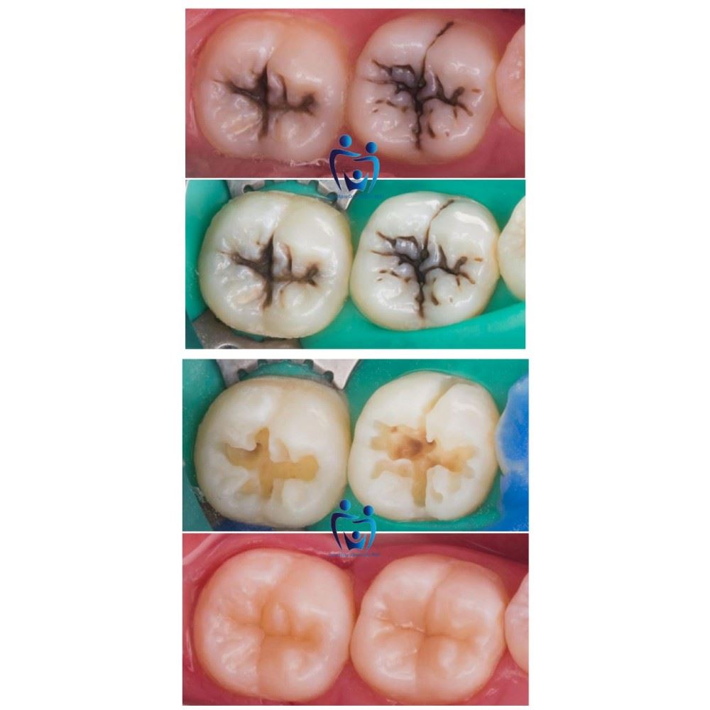 Curta só esse antes e depois ........ Reconstrução do dente oclusal em resina composta..... Fantástico não é?? Tá esperando o que, corra já para o consultório odontológico WDH e nao perca mais tempo !!! 😁 Fotos 100% autorisadas pelo paciente ✔