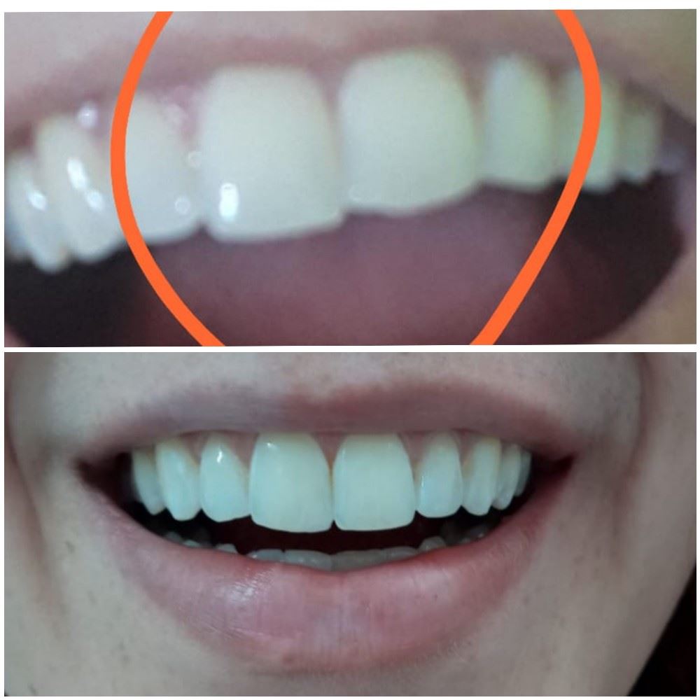 Olha como ficou linda essa faceta ? Feita pelas mãos da Dra Camila Bernardes ........ 


Venha nos fazer uma visita!!! Temos excelentes profissionais capacitados para atende - lo (a) !!! 😁

OBS: Fotos 100% autorizadas pela paciente ❣

Telefones para contato ⬇️
☎️ 3292-4926 ou pelo nosso whatsapp 📲 (35) 99732-4028