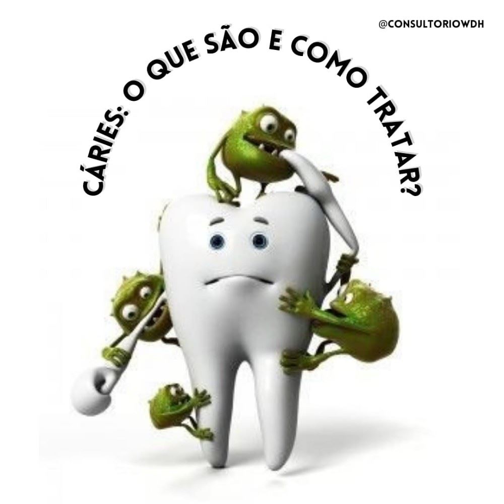 A cárie, também conhecida popularmente como dente podre, é uma infecção dos dentes causada por bactérias naturalmente presentes na boca e que se acumulam formando placas duras e difíceis de serem removidas em casa. Nesta placa, as bactérias vão aos poucos perfurando o esmalte dos dentes e causando dor e desconforto quando chegam nas partes mais profundas dos dentes. A única forma de tratar uma cárie dentária é numa consulta com o cirurgião dentista, não existindo um tratamento caseiro capaz de eliminá-la. Por vezes, basta apenas 1 sessão para eliminar a cárie, com uma restauração do dente, em que é feita a remoção da cárie e de todo o tecido infectado, seguida da aplicação de resina. Quando a cárie é identificada em muitos dentes, o tratamento pode ser mais prolongado, podendo ser preciso recorrer ao tratamento de canal, caso a cárie esteja mais profunda, afetando o nervo do dente. Ou até mesmo à perda do dente, por conta da grande destruição, sem possibilidade de recuperar, que depois precisa ser substituído por uma prótese.
Venha marcar uma avaliação conosco!
📍R. Sete de Setembro, n 14 - Centro
📞 (35) 3292-4926 ou (35) 99732-4038