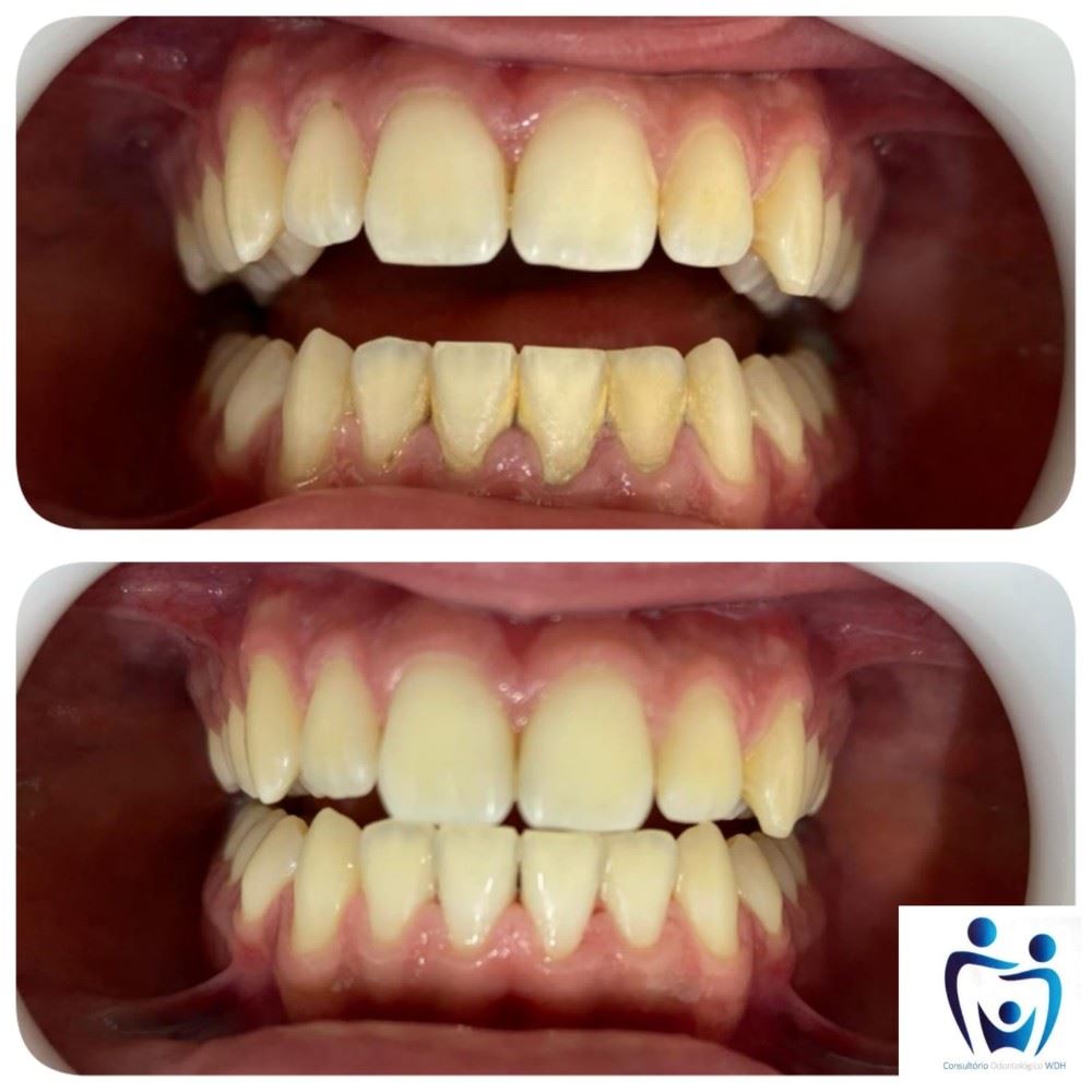 Olhem esse antes e depois de uma limpeza dentária!!! 😱👆🏼
Nós do Consultório WDH, estamos aqui para ajudar você a conquistar aquele belo sorriso! Marque já a sua avaliação conosco 💙
Segunda a sexta: 08h às 18h 
Aos sábados: 08h às 12h 
📍R. Sete de Setembro, n 14 - Centro 
📞 (35) 3292-4926 ou (35) 99732-4038