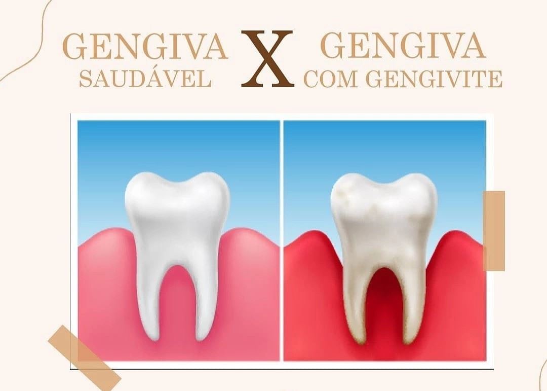 ❗A gengivite é uma inflamação nas gengivas, provocada na maioria dos casos, por uma limpeza bucal inadequada. Entre outros sintomas, a doença causa vermelhidão, sangramento e mau hálito. Sem tratamento, ela evolui para a periodontite, uma inflamação que danifica as estruturas que sustentam o dente e que chega a comprometer a saúde cardiovascular. Mesmo que a gengivite apareça por outros motivos, valorizar a higiene bucal é a regra número um para impedir seu desenvolvimento. Ou seja, use e abuse do fio dental e da escova ao fim de cada refeição. Aliás, manter a escova sempre seca e limpa e trocá-la a cada três meses, evita que ela vire uma mina de bactérias. Visitas regulares ao dentista também ajudam. Venha fazer a sua avaliação conosco! 😄
Segunda a sexta: 08h às 18h
Aos sábados: 08h às 12h
📍R. Sete de Setembro, n 14 - Centro
📞 (35) 99732-4038 ou (35) 3292-4926