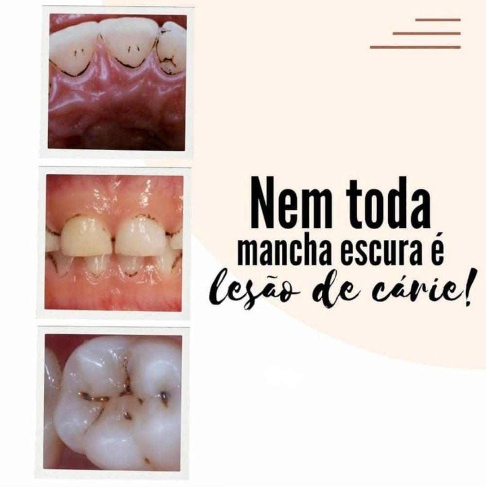 O que são as bactérias cromogênicas? 
⚠️ Os restos de alimentos que ficam na boca, quando a escovação não é feita da forma correta, ajudam na proliferação das bactérias que, em contato com a saliva, podem resultar nas cromogênicas. As manchas provenientes desse tipo de bactéria têm uma pigmentação bem escura, que ficam alojadas próxima a gengiva.
⚠️ Para o tratamento, o dentista irá fazer uma raspagem nas manchas, a chamada profilaxia, que deve ser realizada a cada 6 meses. Por isso a prevenção é sempre o melhor remédio. Quando cuidamos dos nossos dentes, realizando a escovação regular e indo ao consultório periodicamente, diminuímos drasticamente a possibilidade de ter manchas com esse tipo de bactéria.
Agende já a sua avaliação e venha cuidar do seu sorriso no nosso consultório! 💙
Segunda a sexta: 08h às 18h 
Aos sábados: 08h às 12h
📍 R. Sete de Setembro, n 14 - Centro 
📞 (35) 3292-4926 ou (35) 99732-4038