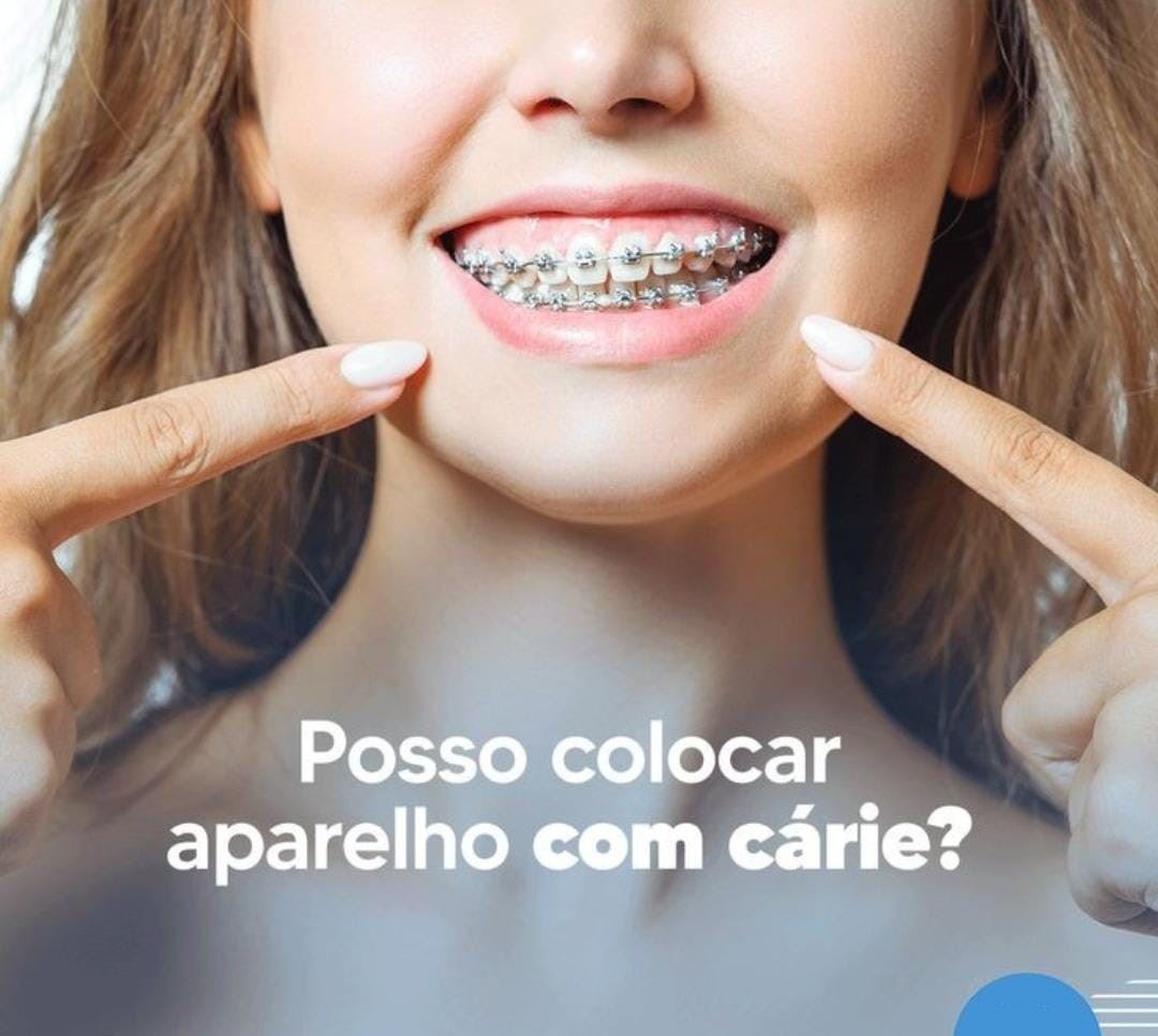 Definitivamente, não. Colocar aparelho com cárie acarreta uma série de problemas ao longo do tempo e ainda dificulta o tratamento que deve ser feito no dente afetado.
Outro fator é que o dente com cárie sofre muito com o acúmulo de bactérias, aumentando o risco de outros problemas.
Antes de colocar aparelho, independentemente do tipo, é preciso realizar todos os tratamentos bucais necessários.
Venha já fazer sua avaliação clínica e ortodôntica no nosso consultório! 😊
Segunda a sexta: 08h às 18h
Aos sábados: 08h às 12h
📍R. Sete de Setembro, n 14 - Centro
📞 (35) 3292-4926 ou (35) 99732-4038