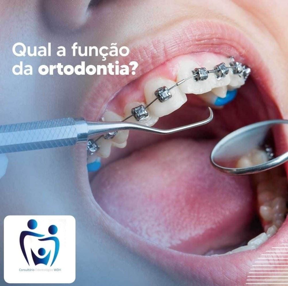 Ortodontia, além da questão estética, está estreitamente ligada à saúde bucal.
Muitas vezes, o que faz o paciente buscar um ortodontista é o desconforto com relação à aparência. Isso não é por acaso. Dentes tortos e/ou desalinhados prejudicam bastante a autoestima.
No entanto, além desse desconforto com relação à aparência, há uma série de outras consequências, quando a posição e alinhamento dos dentes não estão adequados. Como, por exemplo: bruxismo, pequenas fraturas, cáries, gengivite, periodontite, problemas articulares na ATM, entre outras consequências.
Venha fazer uma avaliação no nosso consultório! 😁
Segunda a sexta: 08h às 18h
Aos sábados: 08h às 12h
📍R. Sete de Setembro, n 14 - Centro
📞 (35) 3292-4926 ou (35) 99732-4038