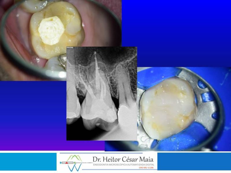 Dr. Heitor César Maia - Canal Endodontia Microscopia