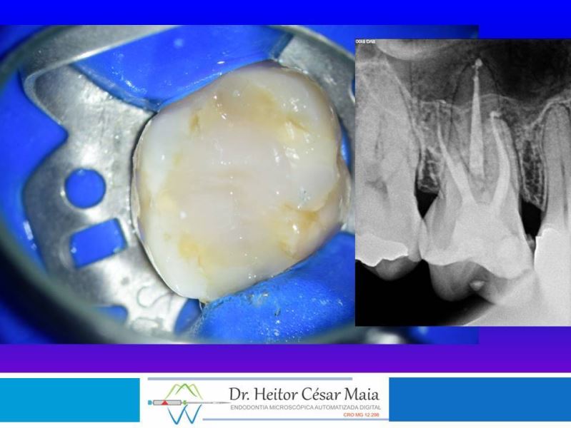 Dr. Heitor César Maia - Canal Endodontia Microscopia