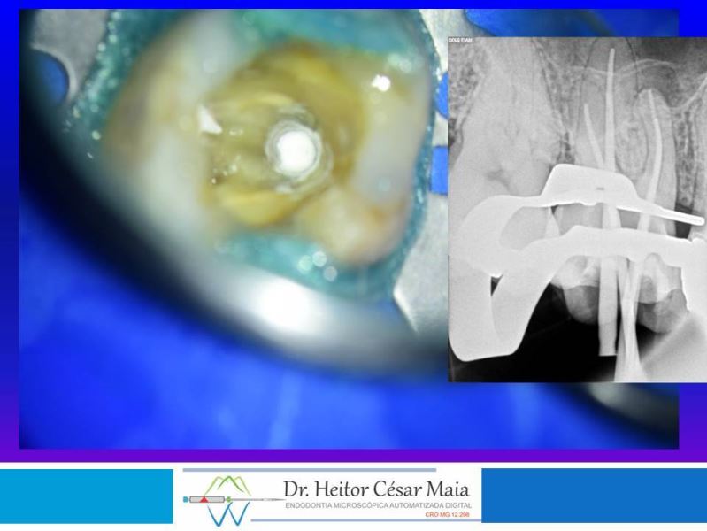 Dr. Heitor César Maia - Canal Endodontia Microscopia