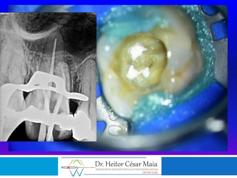 Dr. Heitor César Maia - Canal Endodontia Microscopia