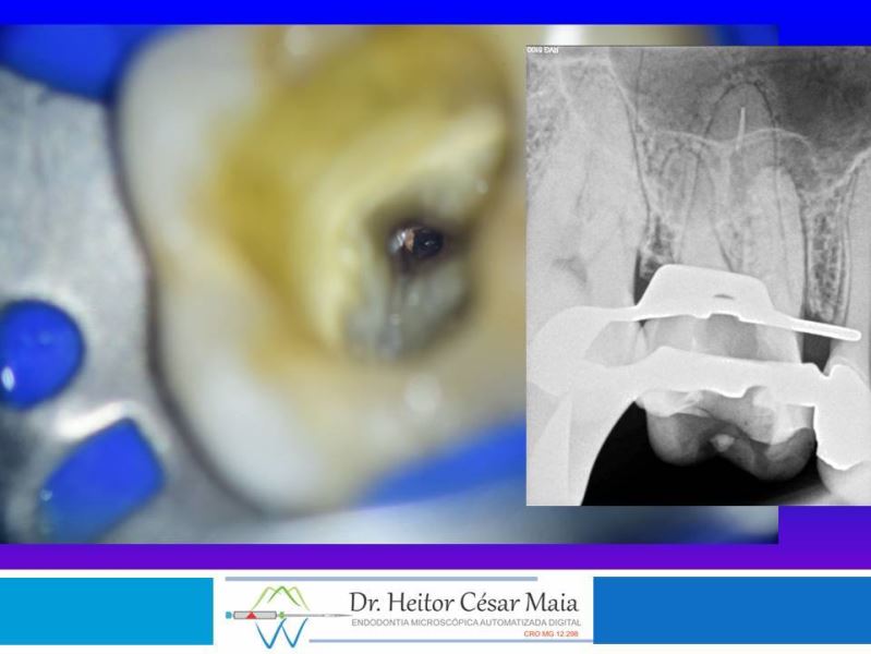 Dr. Heitor César Maia - Canal Endodontia Microscopia