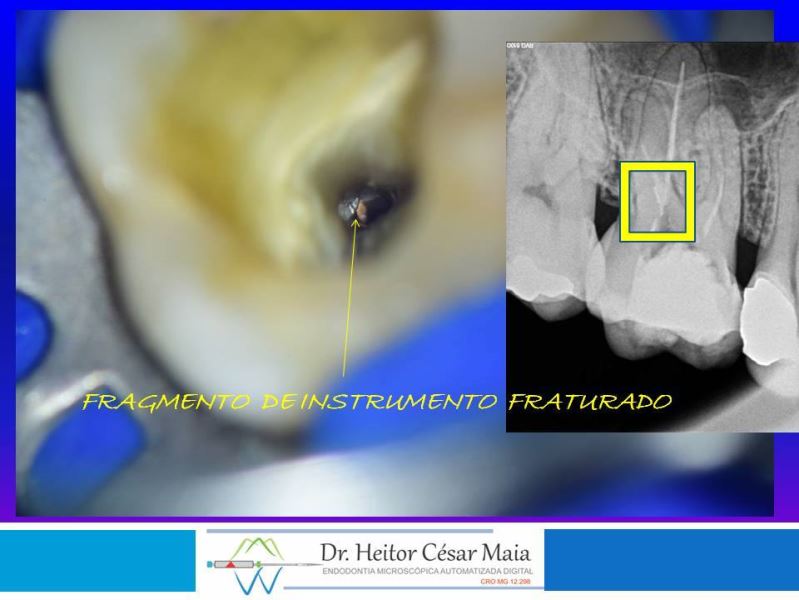 Dr. Heitor César Maia - Canal Endodontia Microscopia