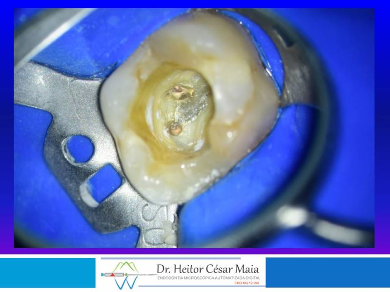 Dr. Heitor César Maia - Canal Endodontia Microscopia