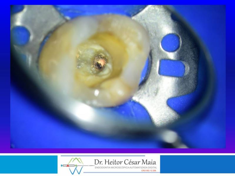 Dr. Heitor César Maia - Canal Endodontia Microscopia