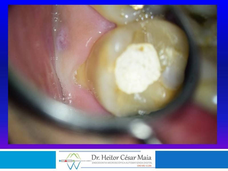 Dr. Heitor César Maia - Canal Endodontia Microscopia