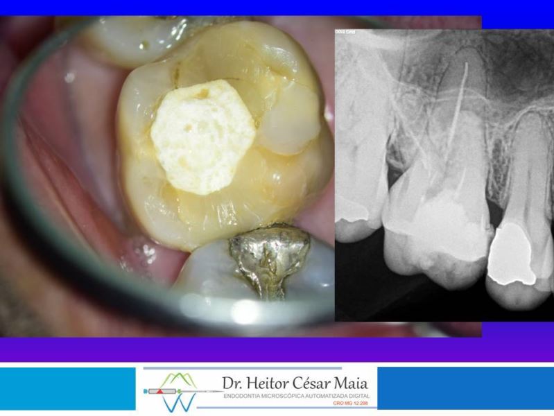 Dr. Heitor César Maia - Canal Endodontia Microscopia