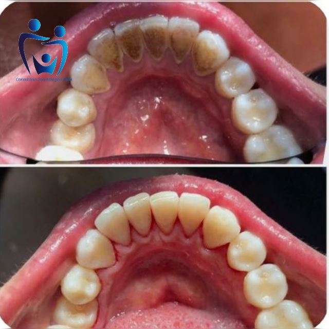 Limpeza + remoção de cálculo!!!