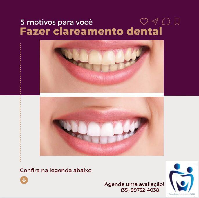 1 - Clareamento dental é seguro 
Por se tratar de uma reação química e não de um procedimento abrasivo o clareamento não afeta, não enfraquece e não destrói a estrutura dos seus dentes 

2 - Aumento da autoestima
Seu sorriso faz parte da sua identidade, é seu “cartão de visita”

3 - Resultado duradouro 
Com uma rotina de cuidado e higienização os resultados são bem duradouros 

4 - Resultados rápidos 
Podemos ter um resultado significativo na primeira sessão ou nos primeiros dias de uso, caso opte por fazer o caseiro 

5 - Tratamento indolor 
Quando você faz o clareamento em uma clínica especializada, o dentista protege sua gengiva e mucosas para evitar qualquer tipo de ferimento, no caso de optar pelo caseiro orientamos o uso adequado e conseguimos controlar a sensibilidade com técnicas adequadas 

Que tal deixar seu sorriso mais iluminado?
